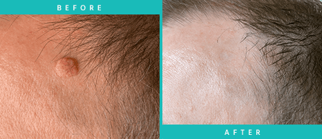 lasaderm-before-after