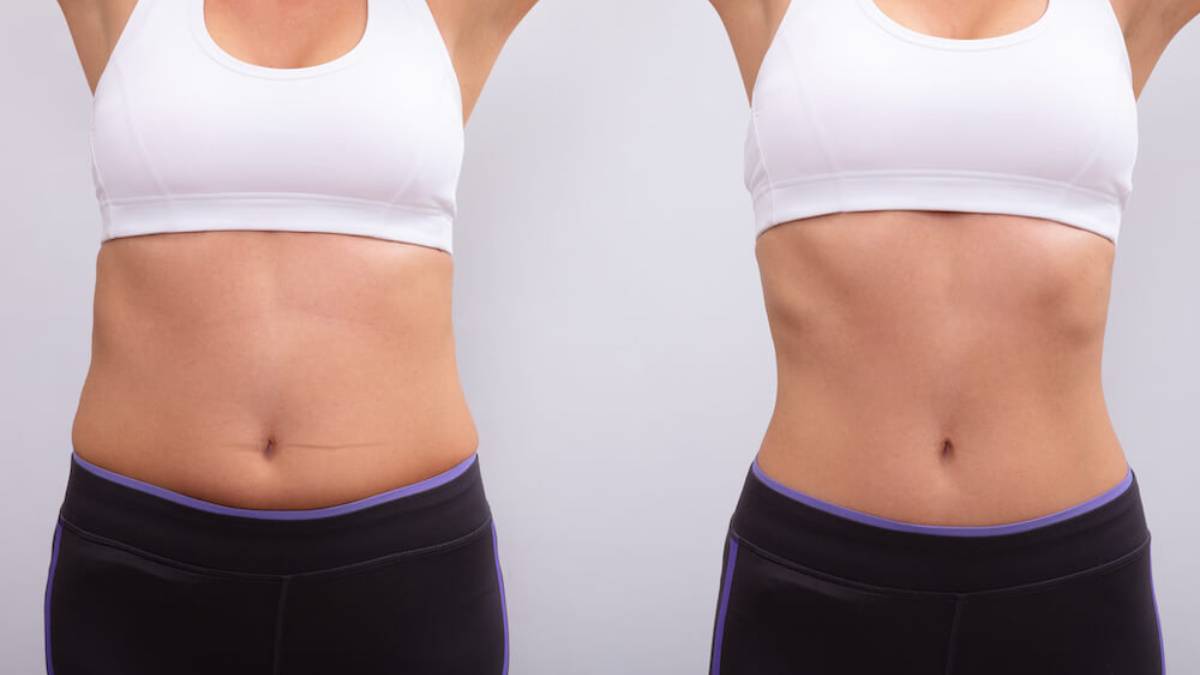 3d lipo on stomach