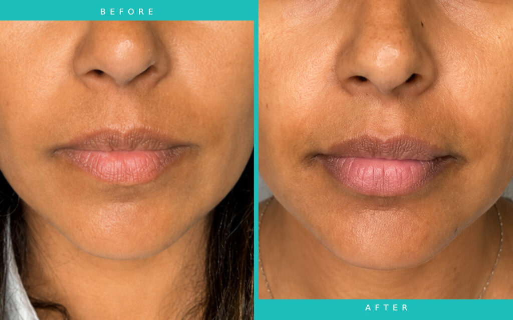 Lip Filler Results