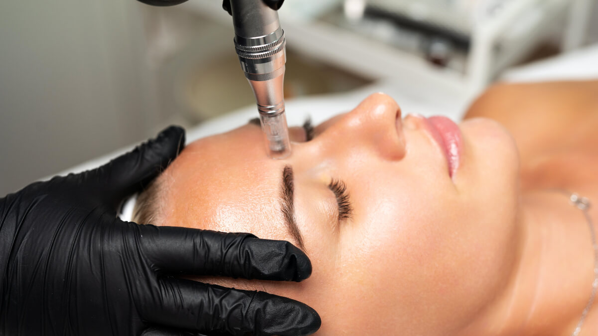 Microneedling