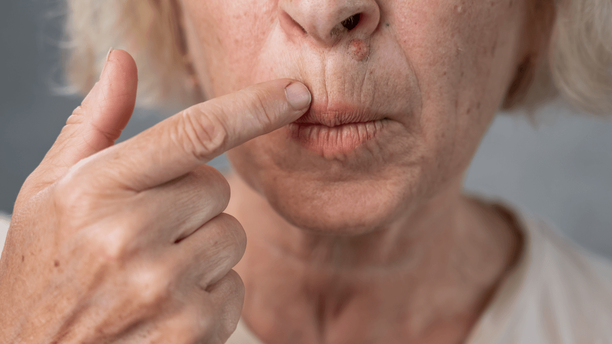 Close-up showing fine lines and wrinkles above the upper lip
