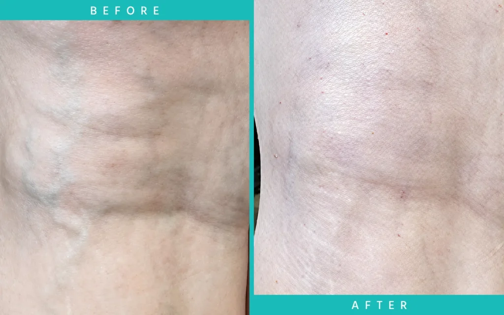 Leg Before After Leg Before After