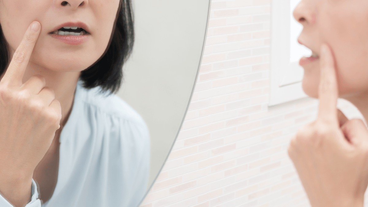 Non surgical PlexR treatment for upper lip lines and smoker's lines