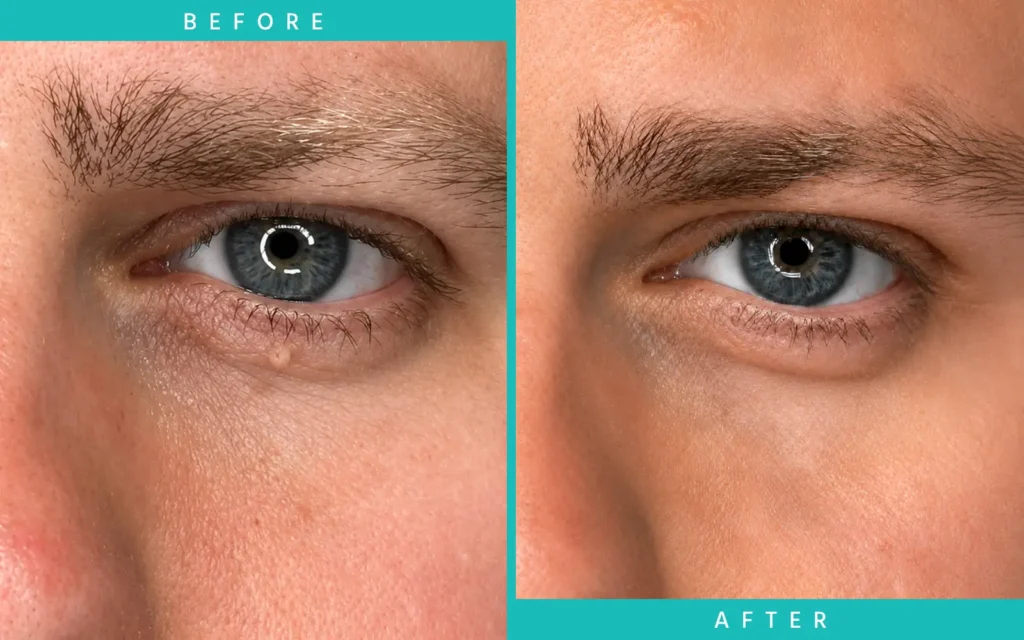 Under Eye Comparison Under Eye Comparison